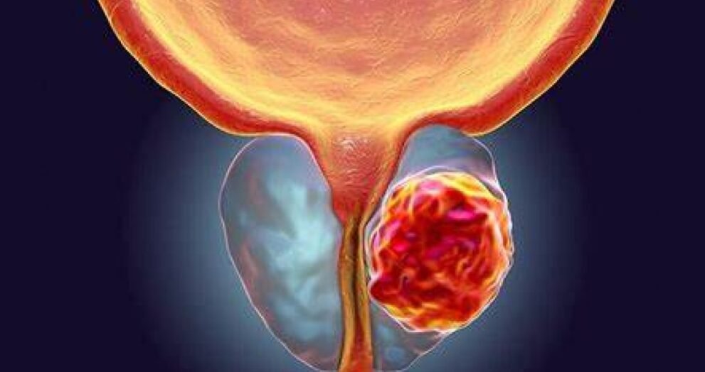 Tem que Ejacular 21 Vezes! Estudo aponta relação entre ejaculação frequente e menor risco de câncer de próstata