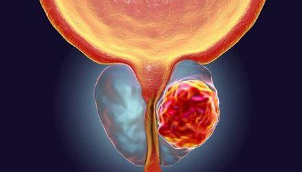 Tem que Ejacular 21 Vezes! Estudo aponta relação entre ejaculação frequente e menor risco de câncer de próstata